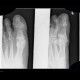 Osteomyelitis of the toe: X-ray - Plain radiograph